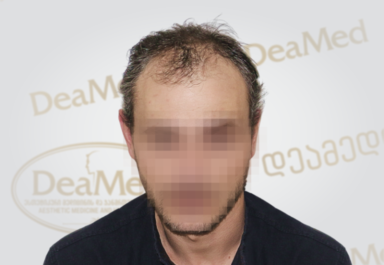 Deamed tmis gadanergvis shedegebi