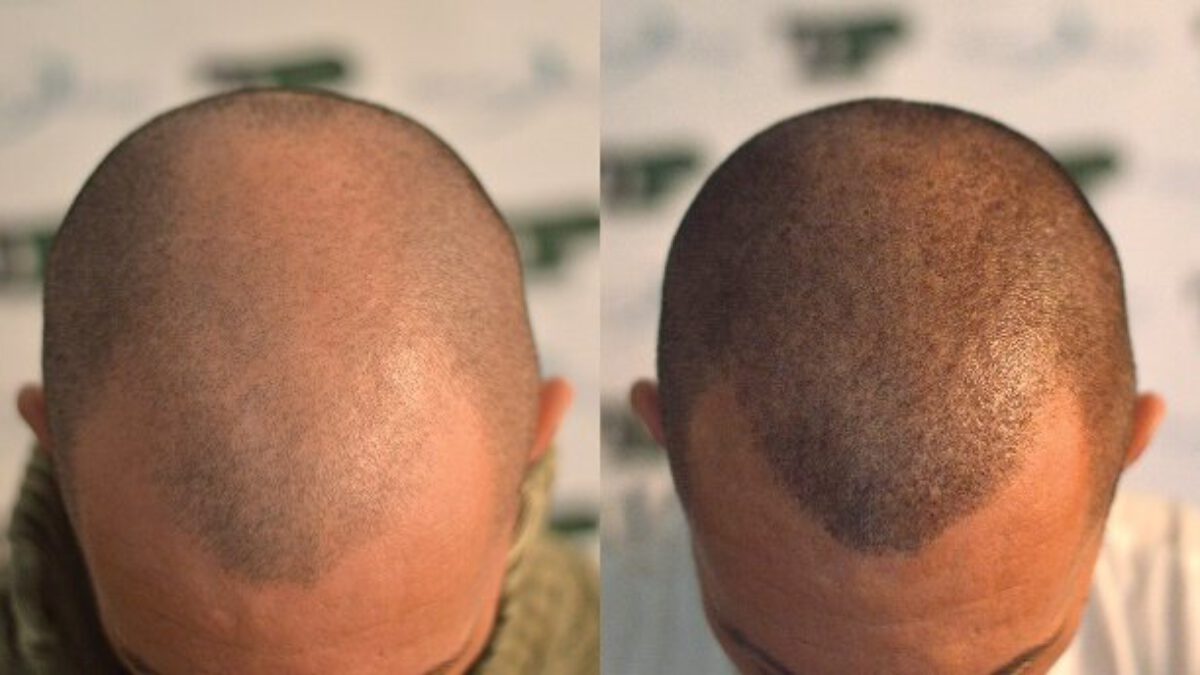 How much does a hair transplant cost and how is it calculated - Deamed