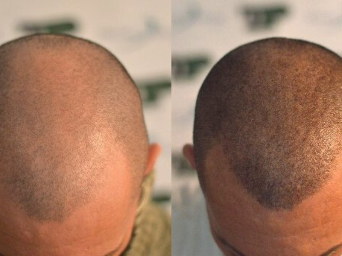How much does a hair transplant cost and how is it calculated - Deamed