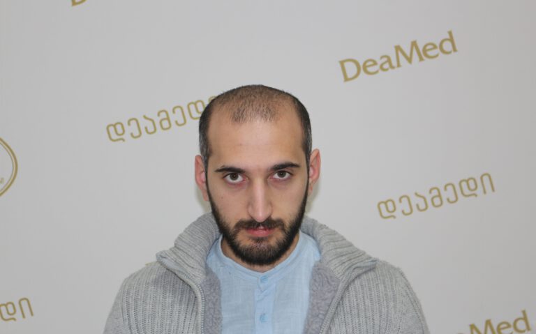 Deamed - hair transplantation results / თმის გადანერგვის შედეგები