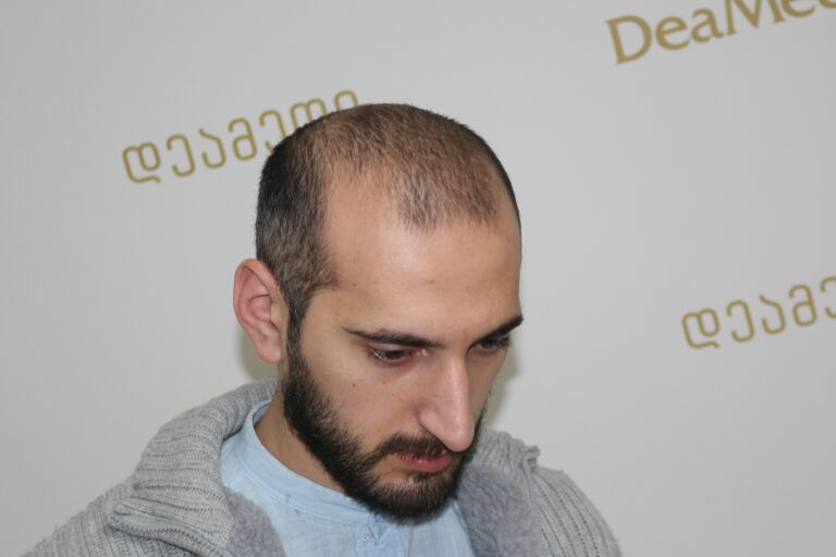 Deamed - hair transplantation results / თმის გადანერგვის შედეგები