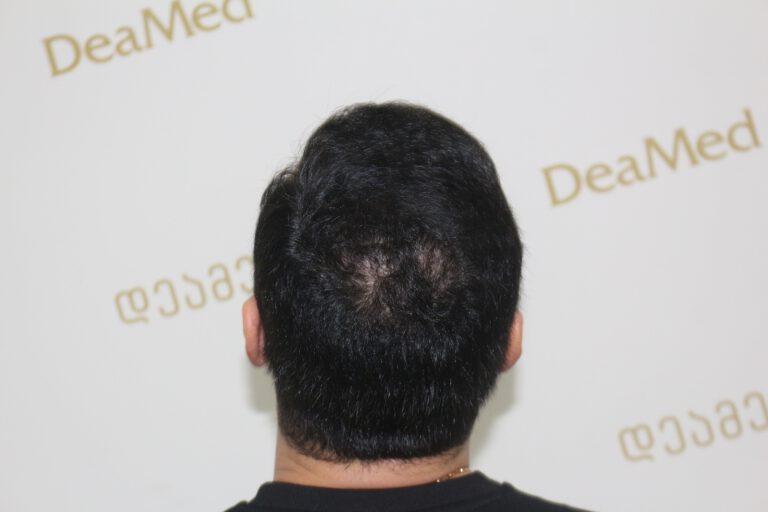 Deamed - hair transplantation results / თმის გადანერგვის შედეგები
