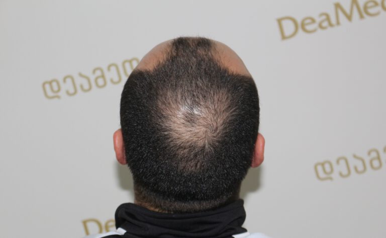 Deamed - hair transplantation results / თმის გადანერგვის შედეგები