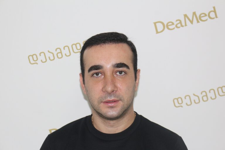 Deamed - hair transplantation results / თმის გადანერგვის შედეგები
