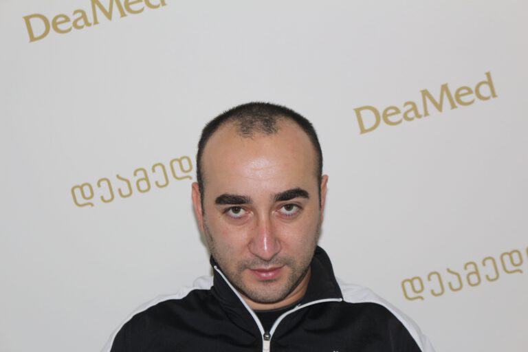 Deamed - hair transplantation results / თმის გადანერგვის შედეგები