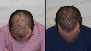 tmis-cvenis-mkurnaloba-hair-loss-treatment