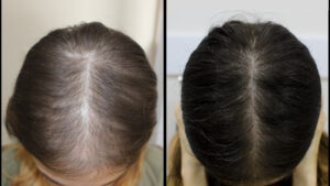 tmis-cvenis-mkurnaloba-hair-loss-treatment.jpg-2