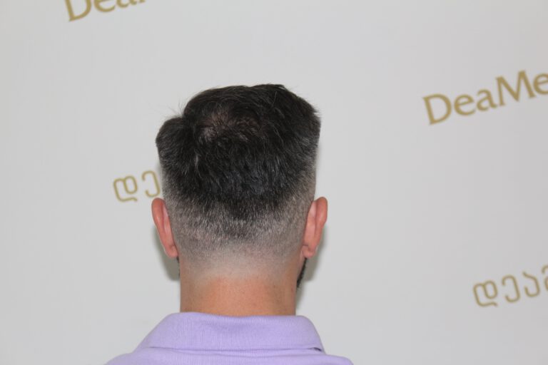 tmis-gadanergva-shedegebi