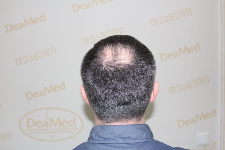 tmis-gadanergva-shedegebi