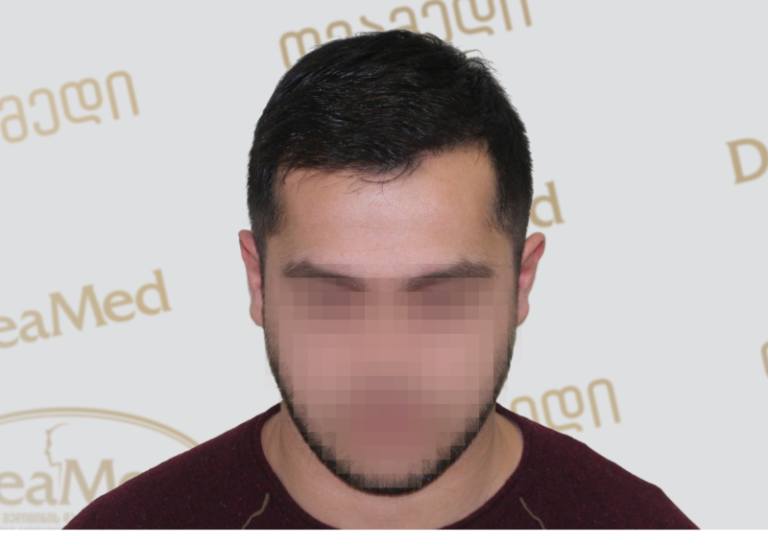 Deamed - hair transplantation results / თმის გადანერგვის შედეგები