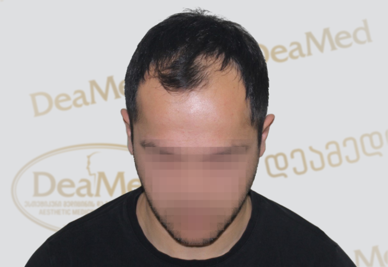 Deamed - hair transplantation results / თმის გადანერგვის შედეგები