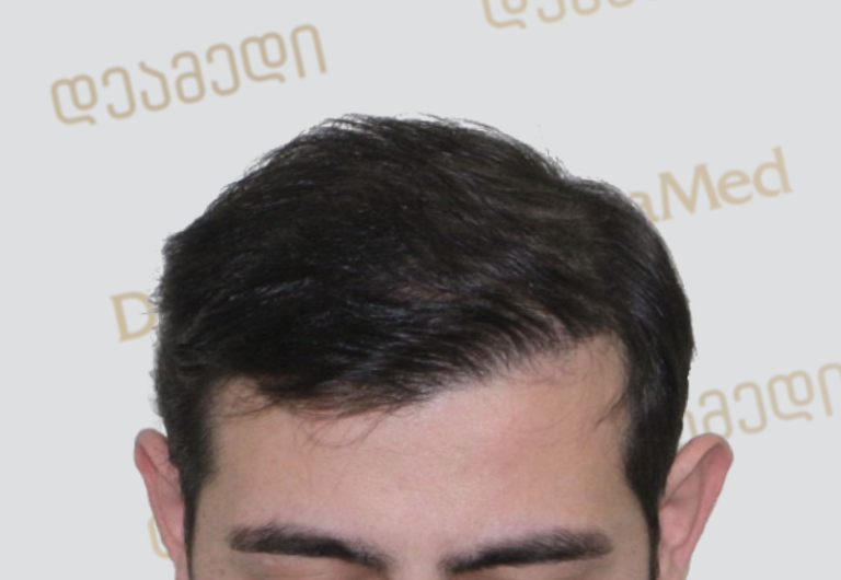 Deamed - hair transplantation results / თმის გადანერგვის შედეგები