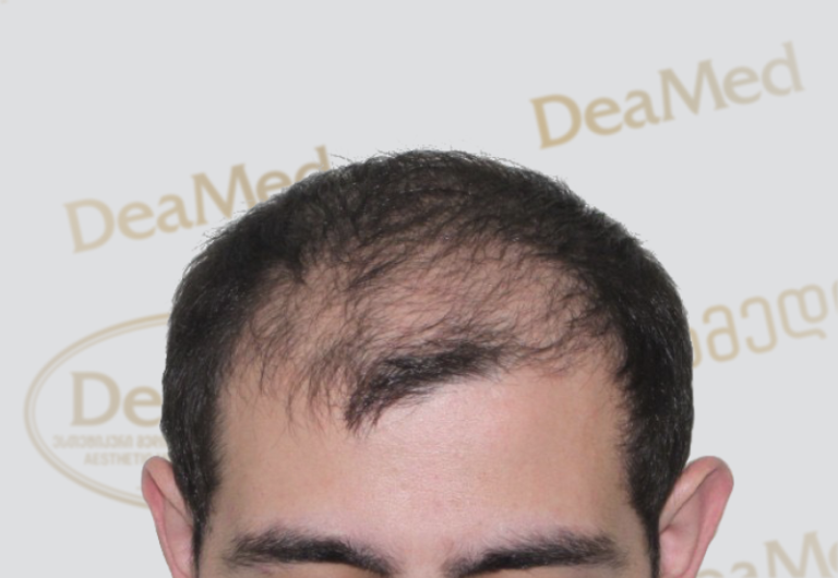 Deamed - hair transplantation results / თმის გადანერგვის შედეგები