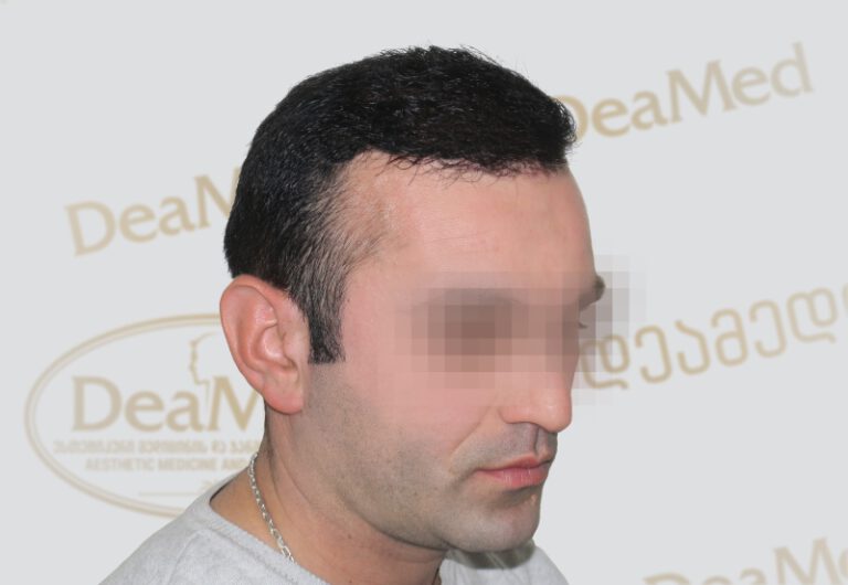 Deamed - hair transplantation results / თმის გადანერგვის შედეგები