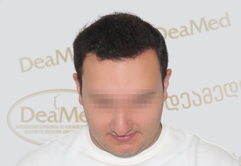 Deamed - hair transplantation results / თმის გადანერგვის შედეგები
