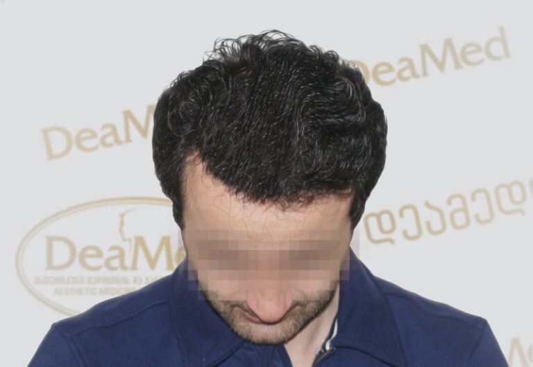 Deamed - hair transplantation results / თმის გადანერგვის შედეგები