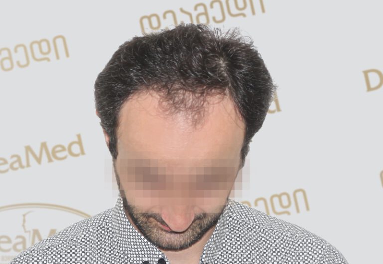 Deamed - hair transplantation results / თმის გადანერგვის შედეგები