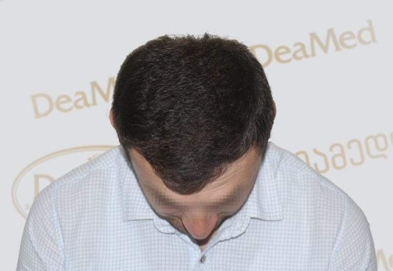 Deamed - hair transplantation results / თმის გადანერგვის შედეგები