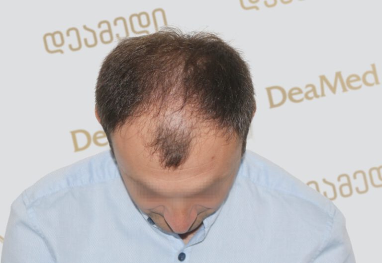 Deamed - hair transplantation results / თმის გადანერგვის შედეგები