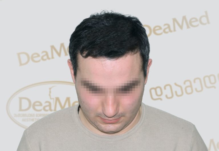Deamed - hair transplantation results / თმის გადანერგვის შედეგები