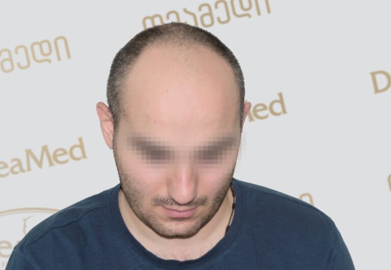 Deamed - hair transplantation results / თმის გადანერგვის შედეგები
