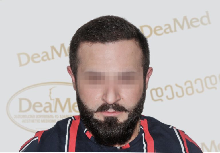 tmis-gadanergva-hair-transplantation-After