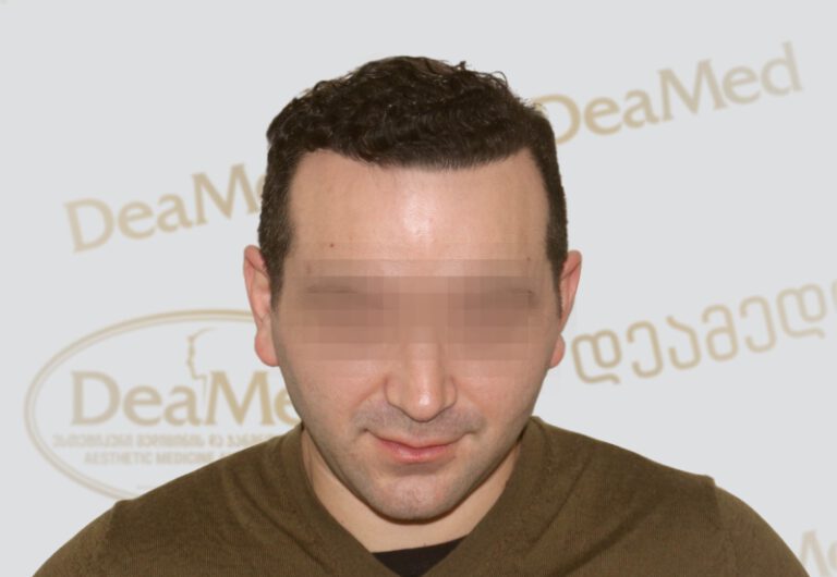 tmis-gadanergva-hair-transplantation-After