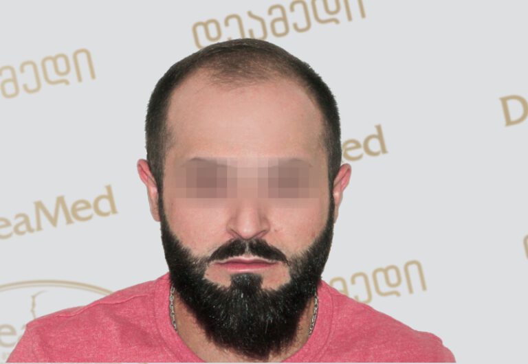 tmis-gadanergva-hair-transplantation-Before
