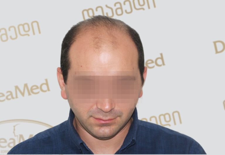 tmis-gadanergva-hair-transplantation-Before
