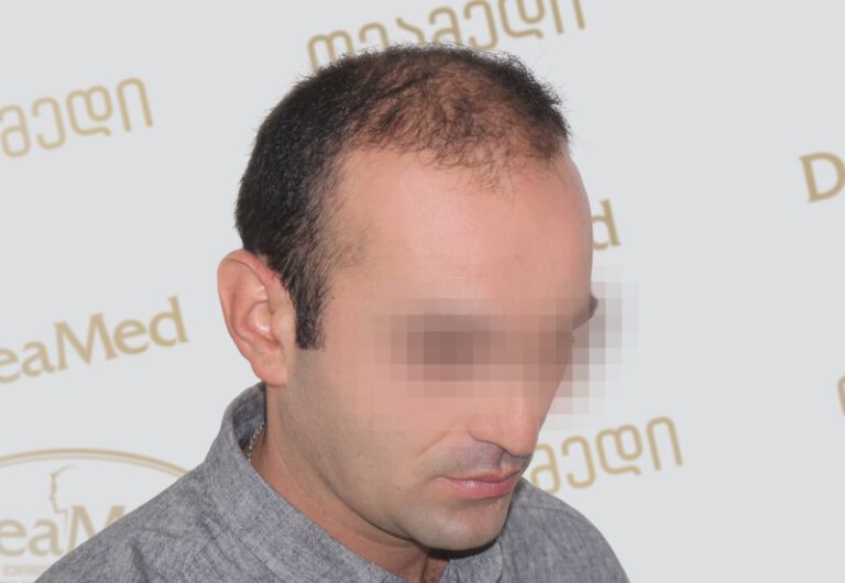 tmis-gadanergva-hair-transplantation-before