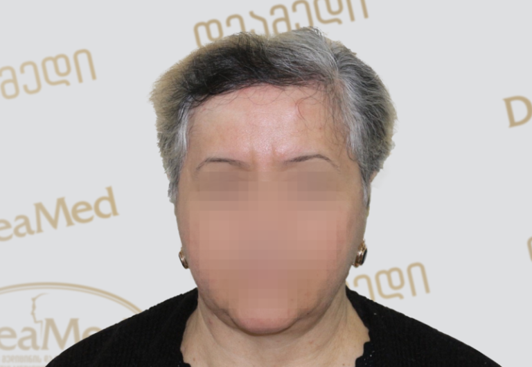 Deamed - hair transplantation results / თმის გადანერგვის შედეგები