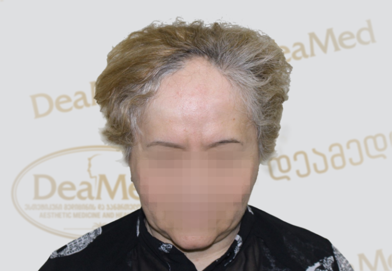 Deamed - hair transplantation results / თმის გადანერგვის შედეგები