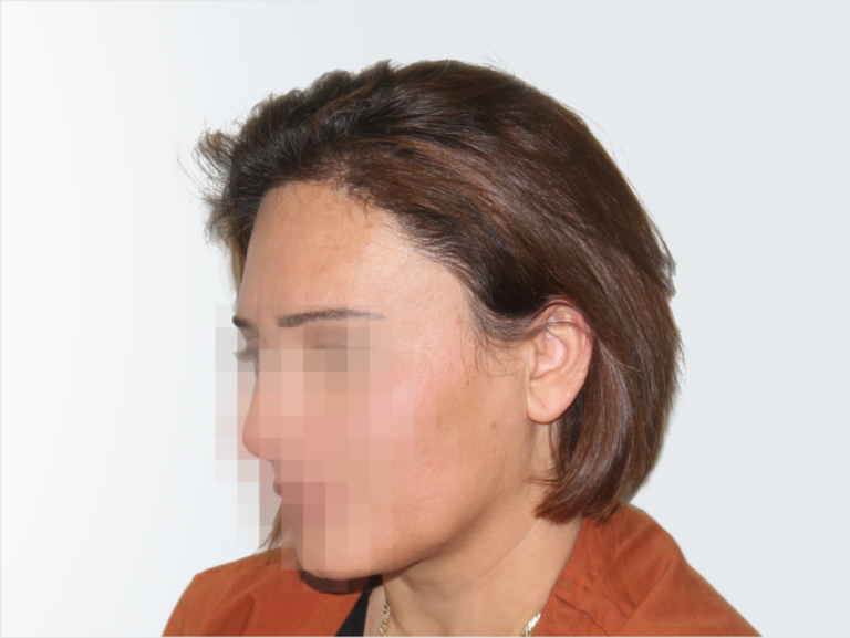 Deamed - hair transplantation results / თმის გადანერგვის შედეგები