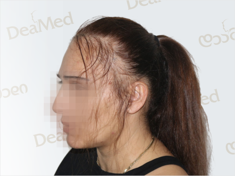 Deamed - hair transplantation results / თმის გადანერგვის შედეგები