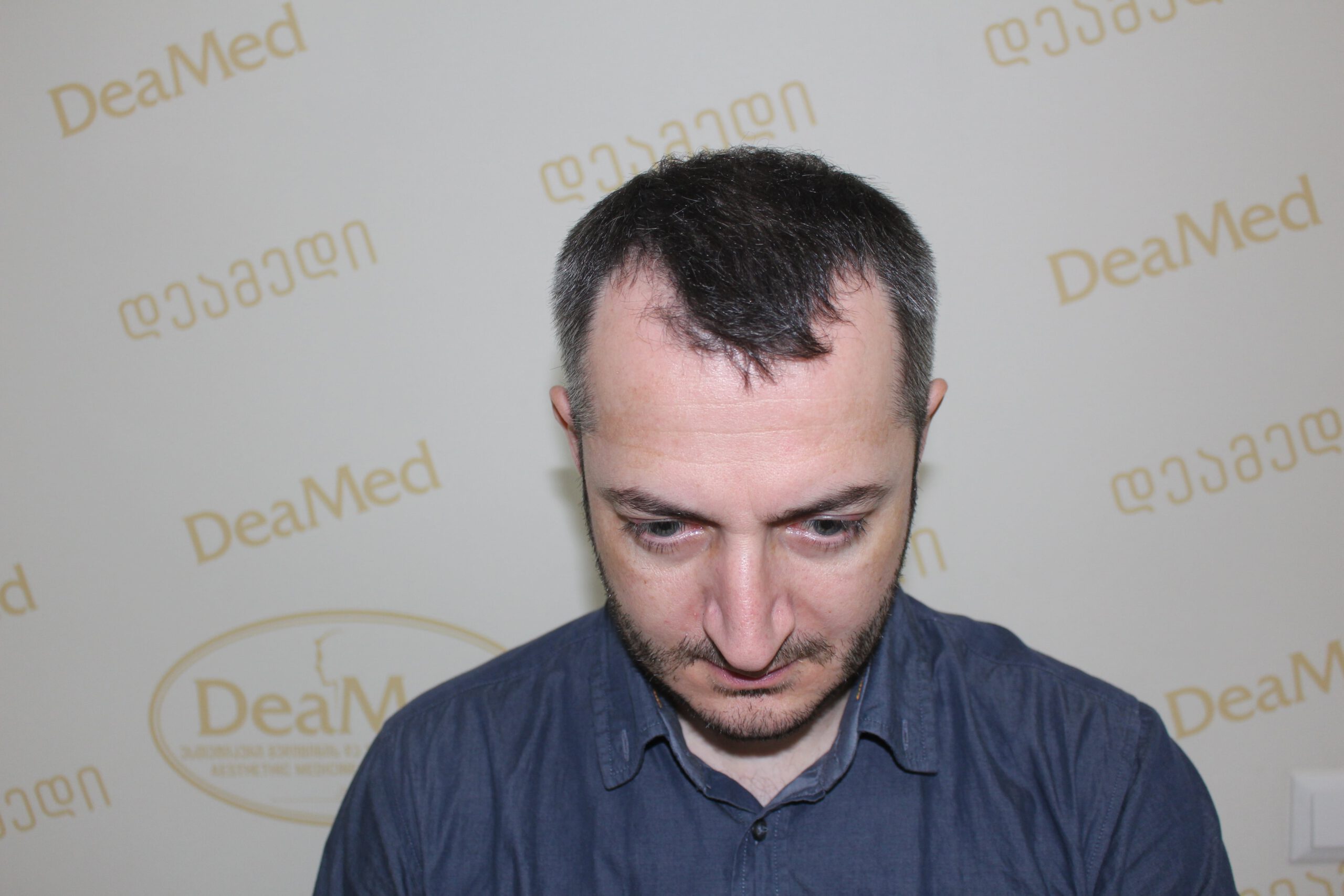 tmis-gadanergva-shedegebi