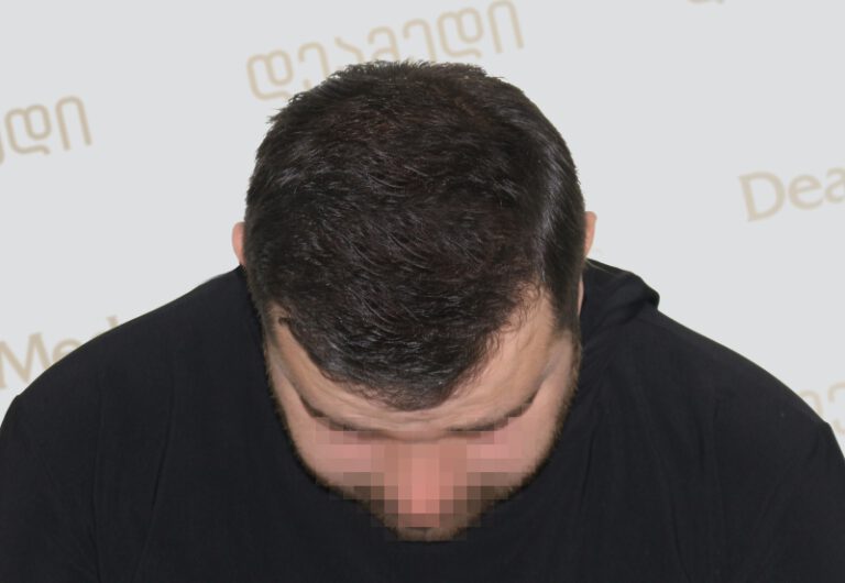 Deamed - hair transplantation results / თმის გადანერგვის შედეგები