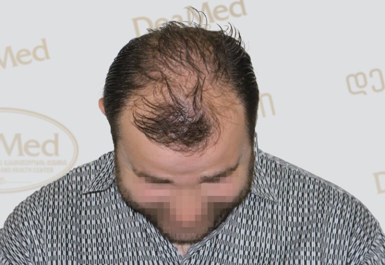 Deamed - hair transplantation results / თმის გადანერგვის შედეგები