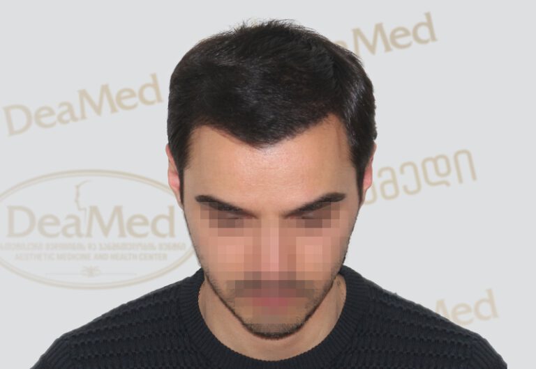 Deamed - hair transplantation results / თმის გადანერგვის შედეგები