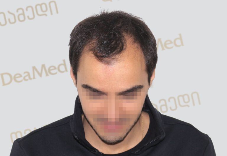 Deamed - hair transplantation results / თმის გადანერგვის შედეგები