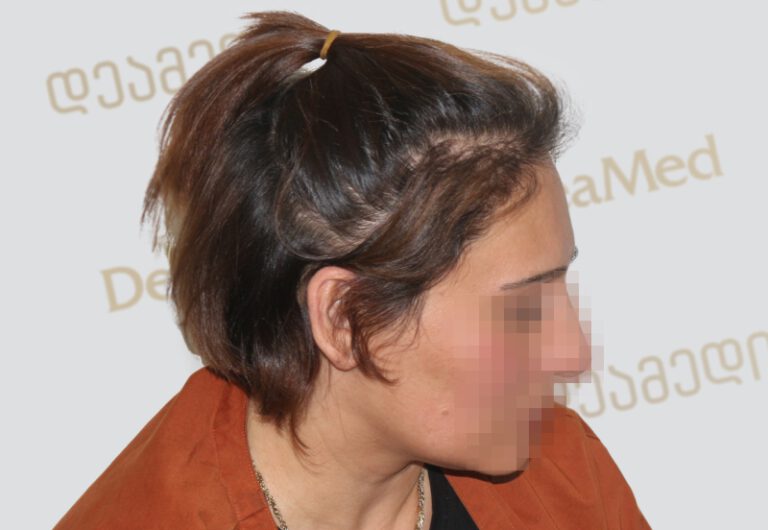 Deamed - hair transplantation results / თმის გადანერგვის შედეგები