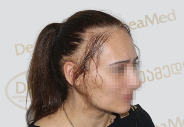 Deamed - hair transplantation results / თმის გადანერგვის შედეგები