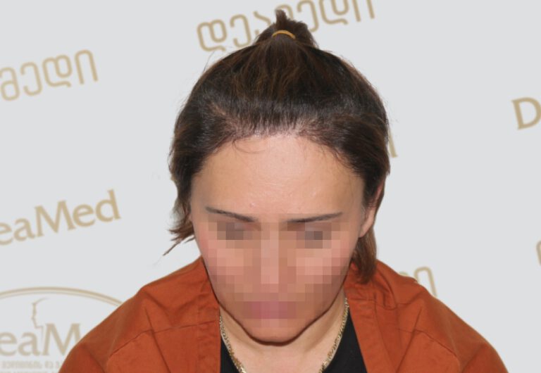 Deamed - hair transplantation results / თმის გადანერგვის შედეგები