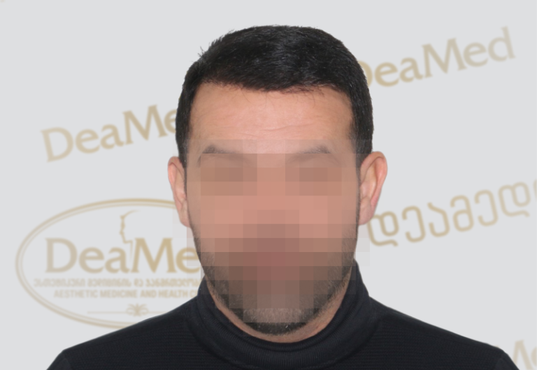 Deamed - hair transplantation results / თმის გადანერგვის შედეგები