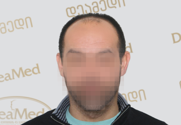 Deamed - hair transplantation results / თმის გადანერგვის შედეგები
