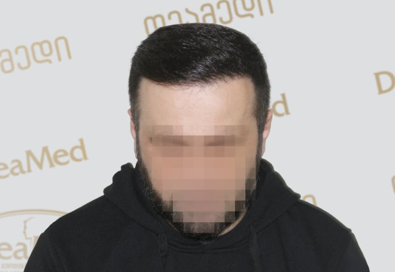 Deamed - hair transplantation results / თმის გადანერგვის შედეგები