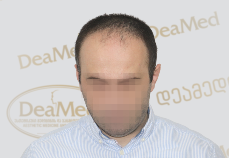 Deamed - hair transplantation results / თმის გადანერგვის შედეგები