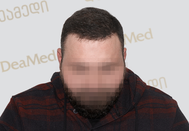 Deamed - hair transplantation results / თმის გადანერგვის შედეგები