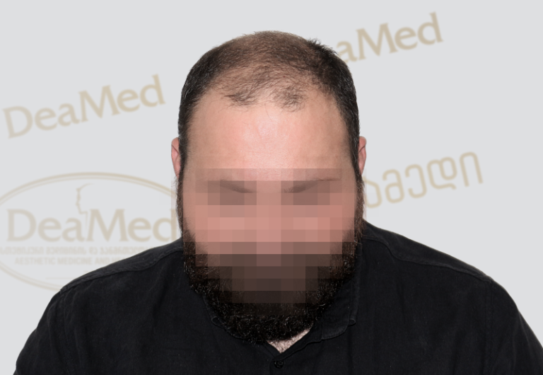 Deamed - hair transplantation results / თმის გადანერგვის შედეგები