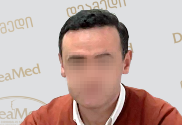 Deamed - hair transplantation results / თმის გადანერგვის შედეგები