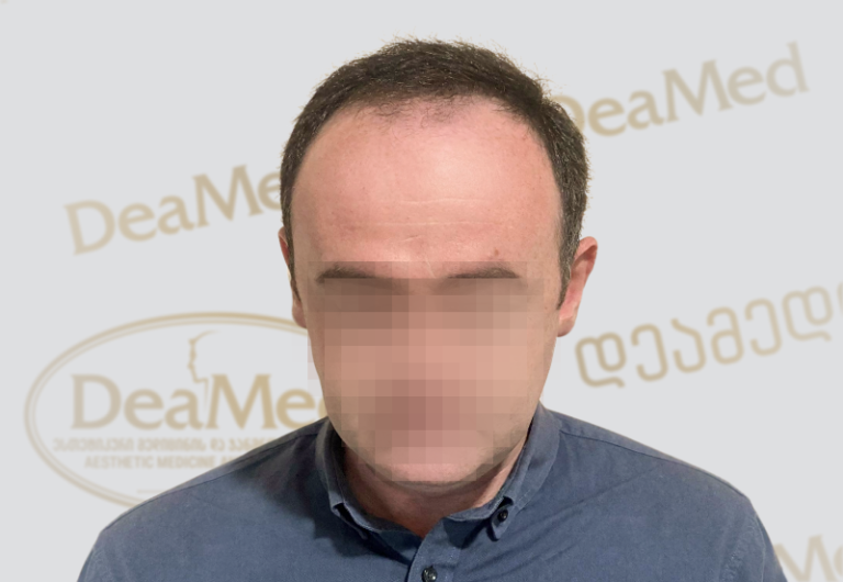 Deamed - hair transplantation results / თმის გადანერგვის შედეგები